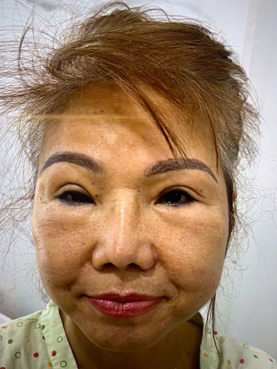 Căng da mặt ít xâm lấn ( Facial Threads Lift)