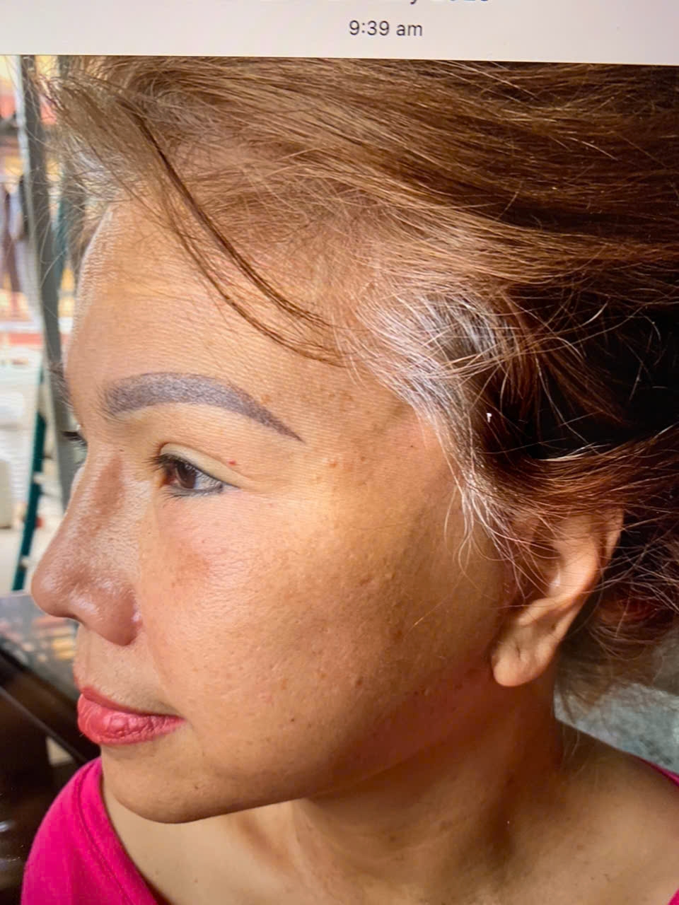Căng da mặt ít xâm lấn ( Facial Threads Lift)