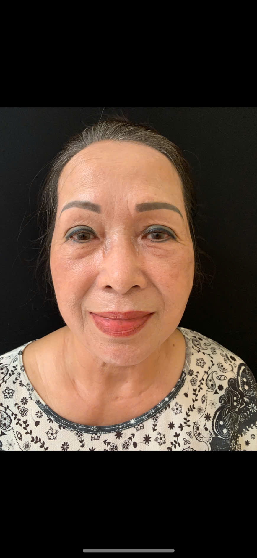 Căng da mặt ít xâm lấn ( Facial Threads Lift)