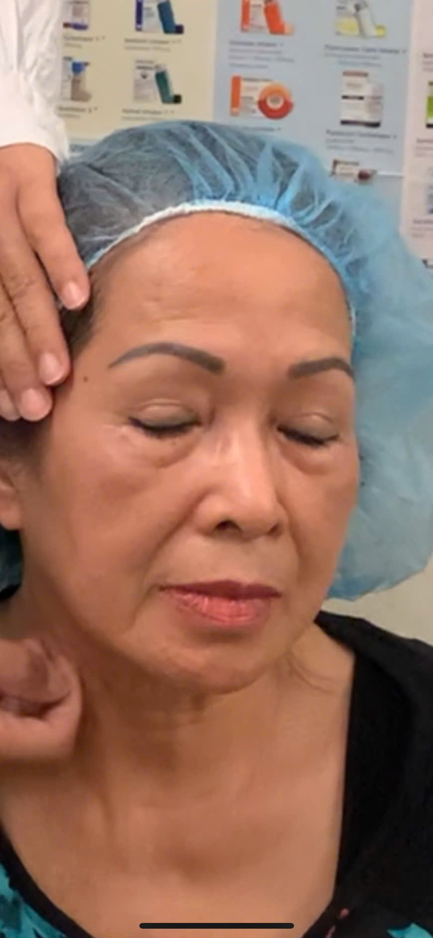 Căng da mặt ít xâm lấn ( Facial Threads Lift)