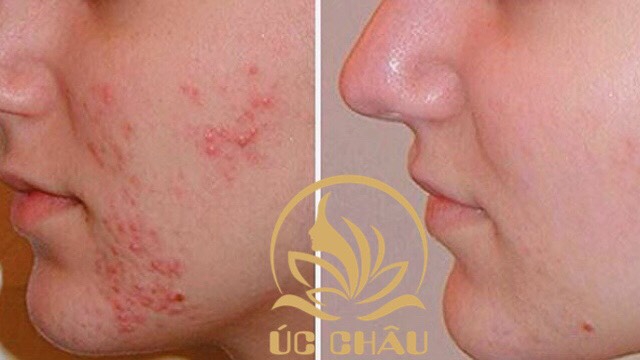 Điều trị Da chuyên sâu Điều trị Da chuyên sâu