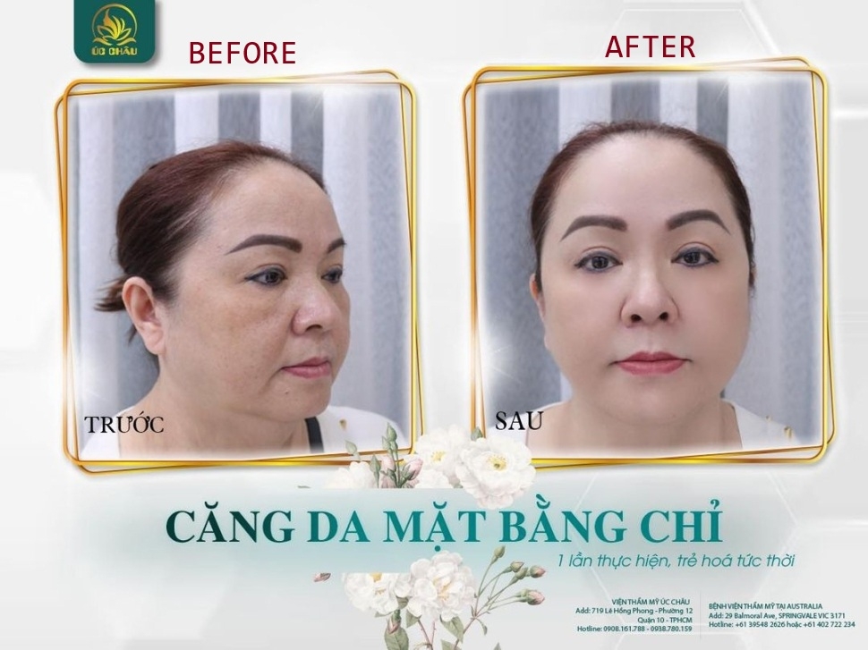 Facial Threads Lift