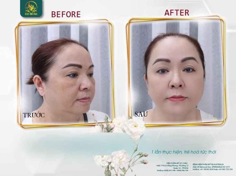 Facial Threads Lift
