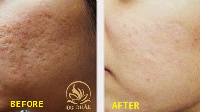 Laser Skin Treatment