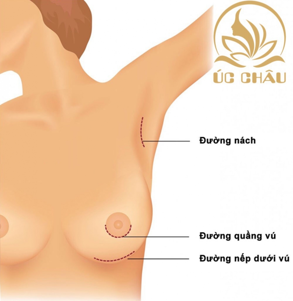 Breast Augmentation
