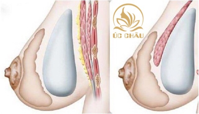 Breast Augmentation