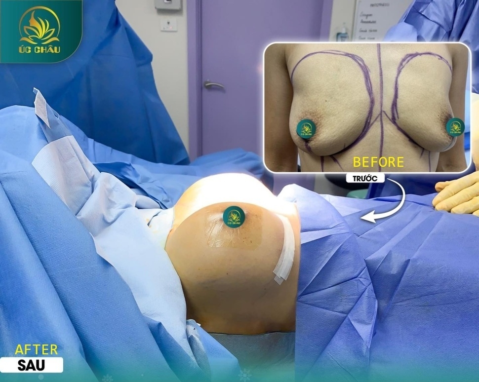 Breast Augmentation