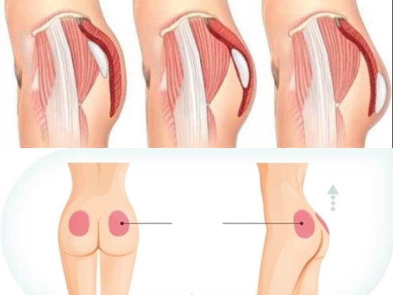 Buttock Augmentation