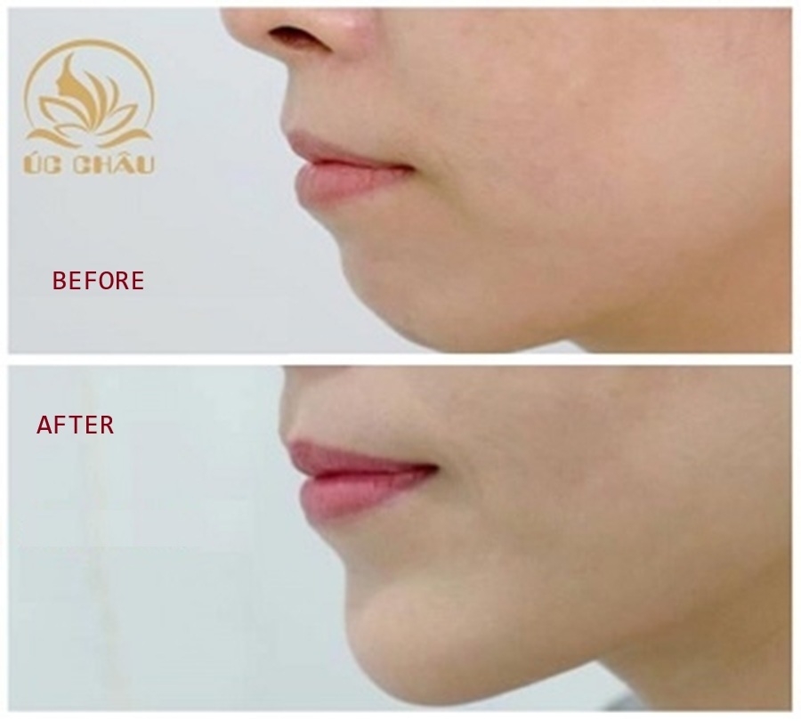 Chin Augmentation Chin Augmentation