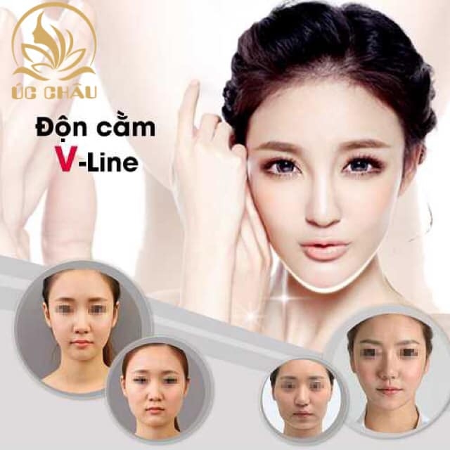 Độn cằm Vline
