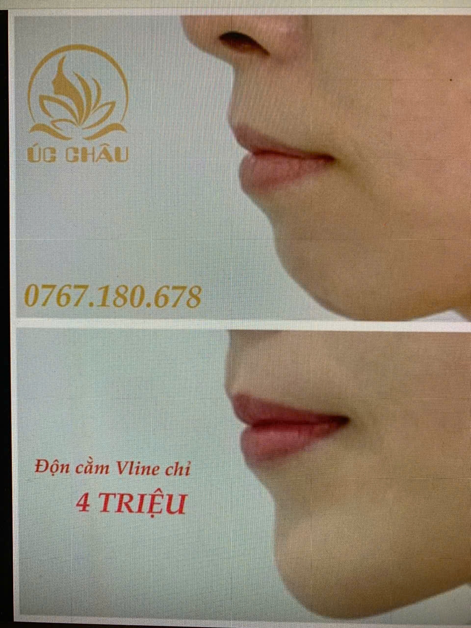 Độn cằm Vline