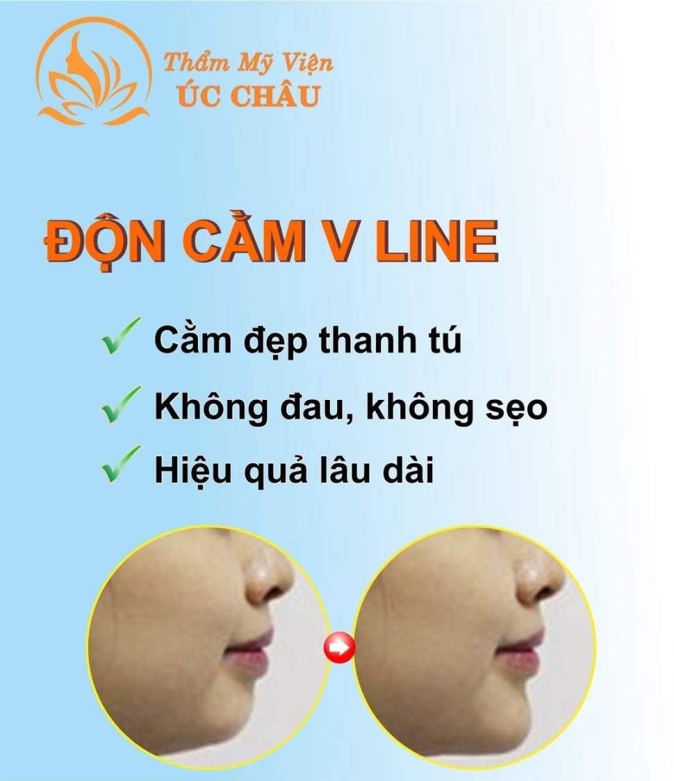 Độn cằm Vline Độn cằm Vline