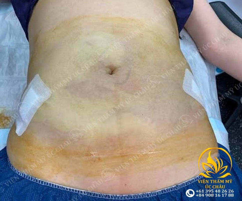 Hút mỡ căng da bụng: Liposuction