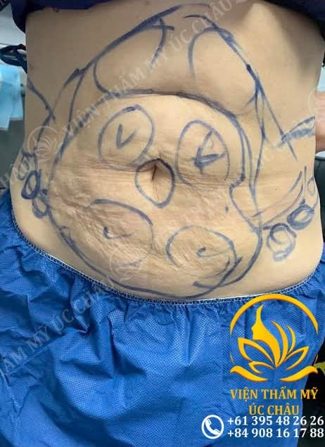 Hút mỡ căng da bụng: Liposuction