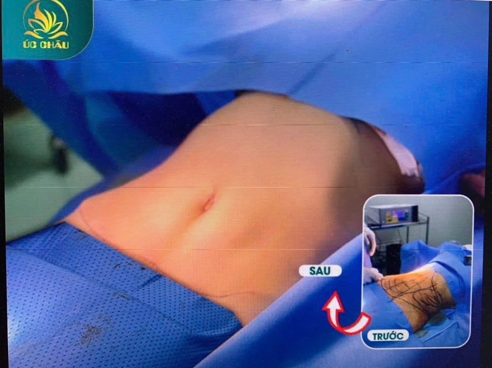 Hút mỡ căng da bụng: Liposuction