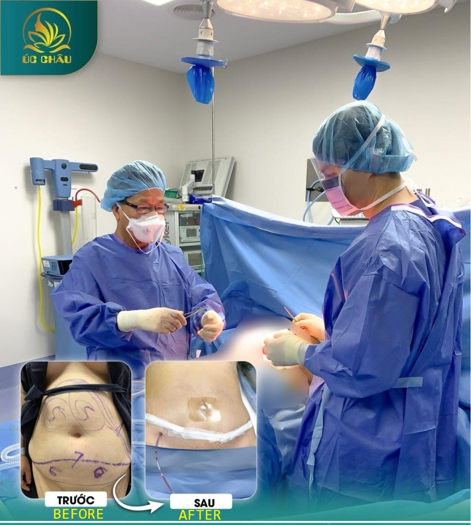 Lipo-abdominoplasty