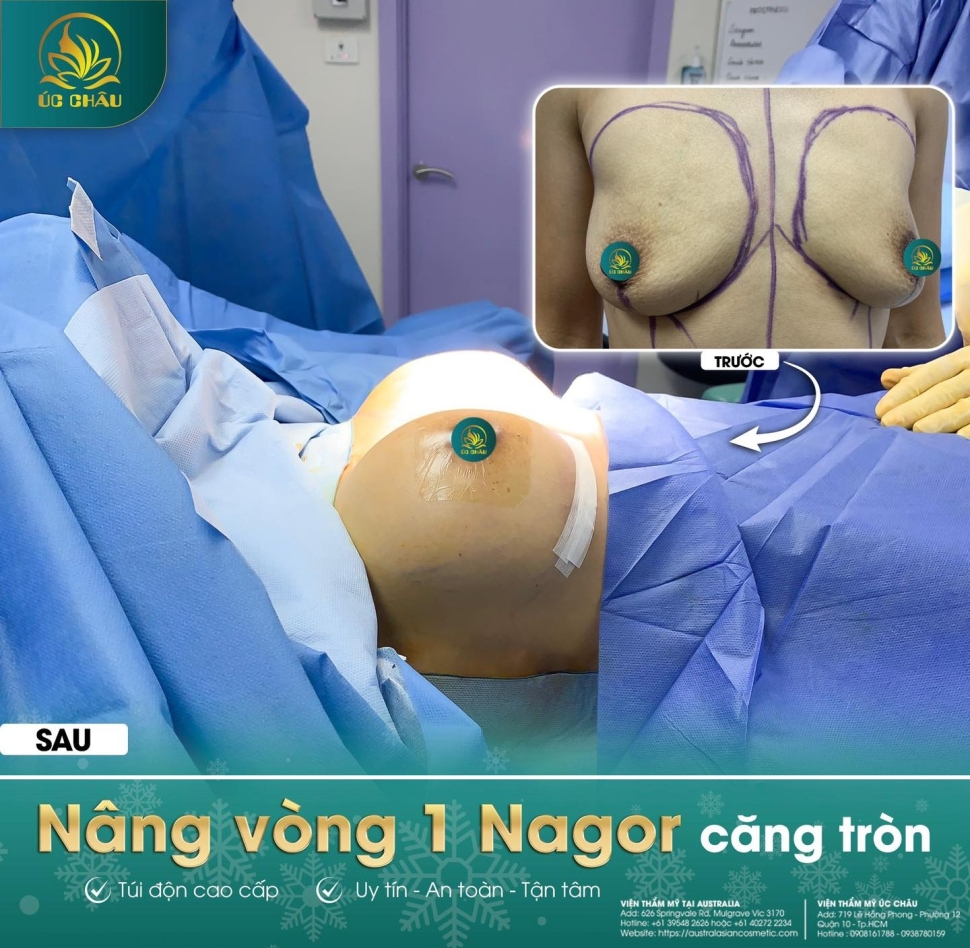 Nâng Vòng 1: Breast Augmentation