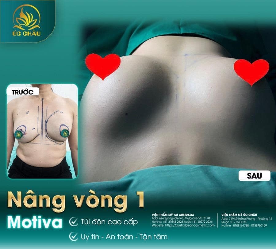 Nâng Vòng 1: Breast Augmentation