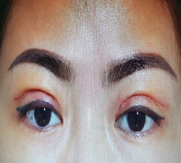 Upper and Lower Eye Lids Surgery