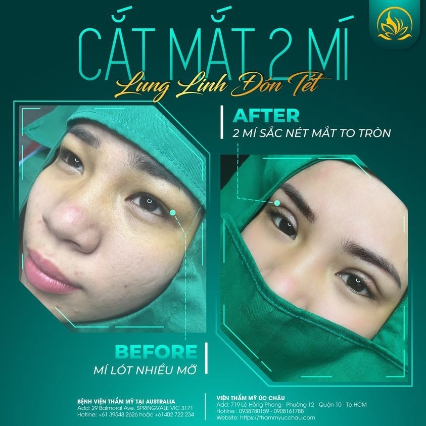Upper and Lower Eye Lids Surgery Upper and Lower Eye Lids Surgery