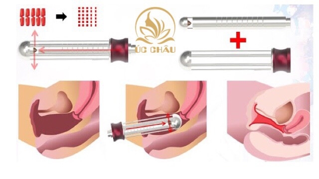 Vaginal Laser Rejuvenation
