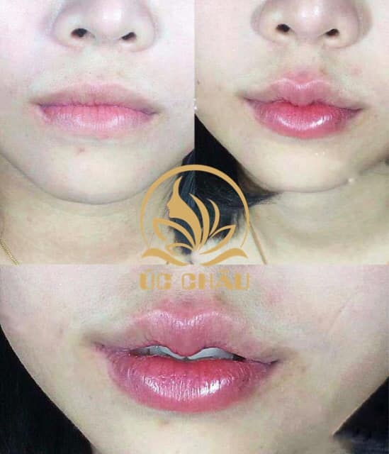 Tạo hình thẩm mỹ Môi