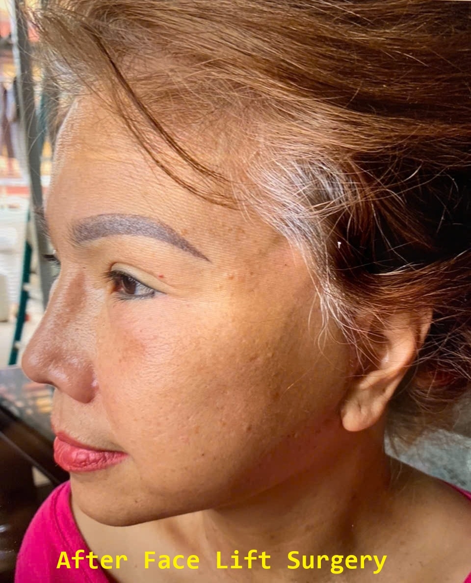 Face Lift