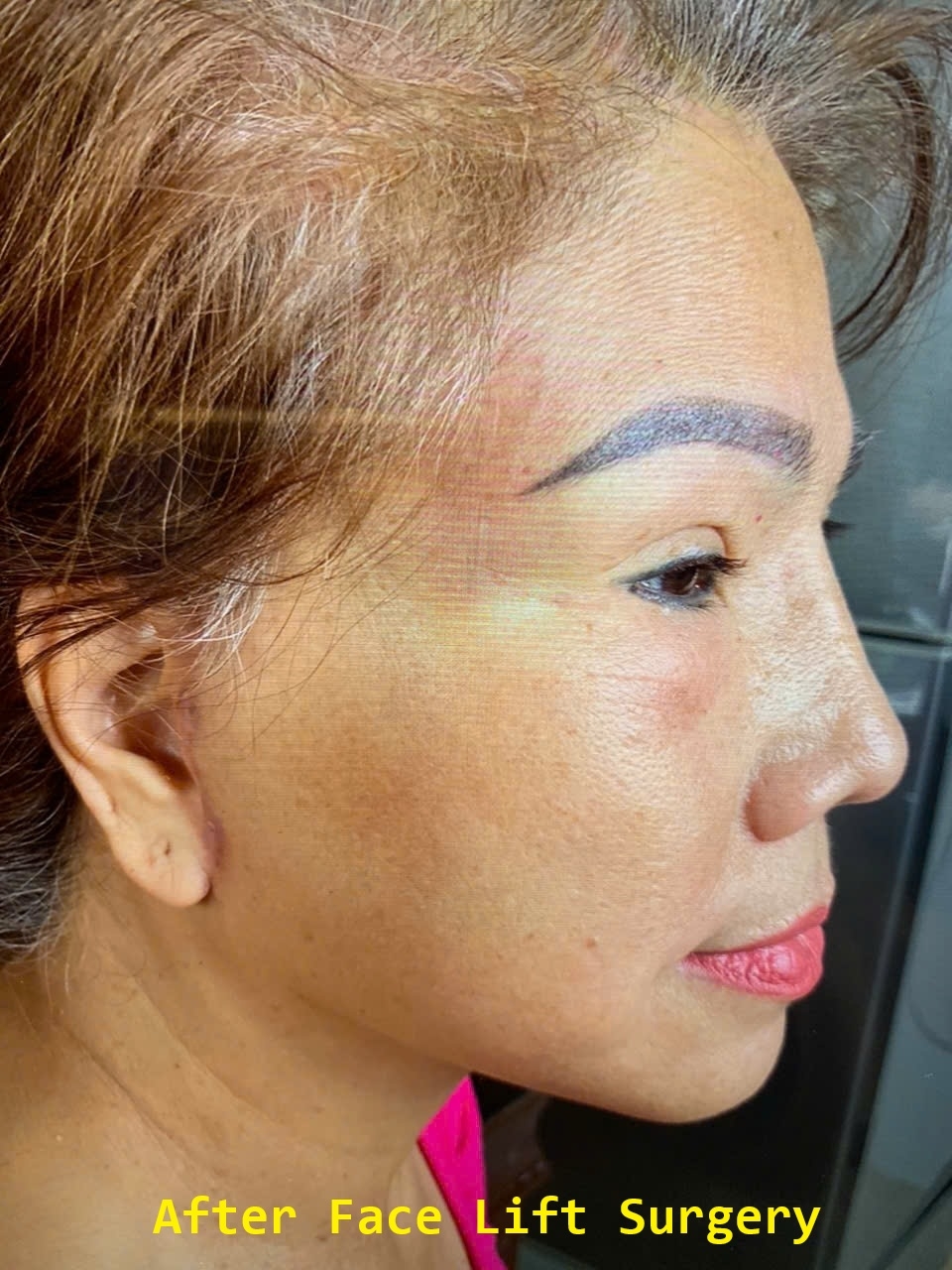 Face Lift