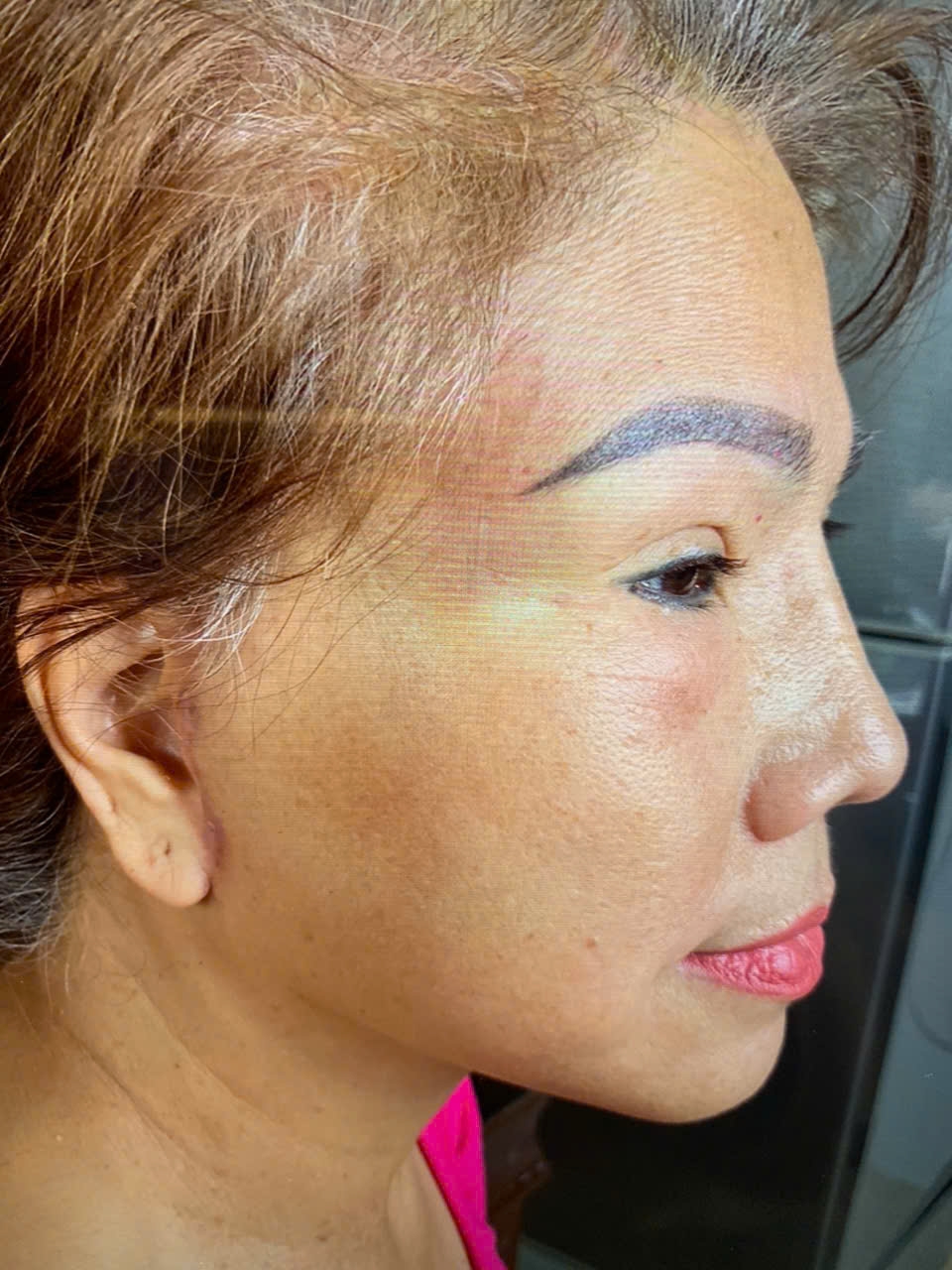Phẫu Thuật Căng Da Mặt Toàn Phần ( Deep Plane Face Lift )