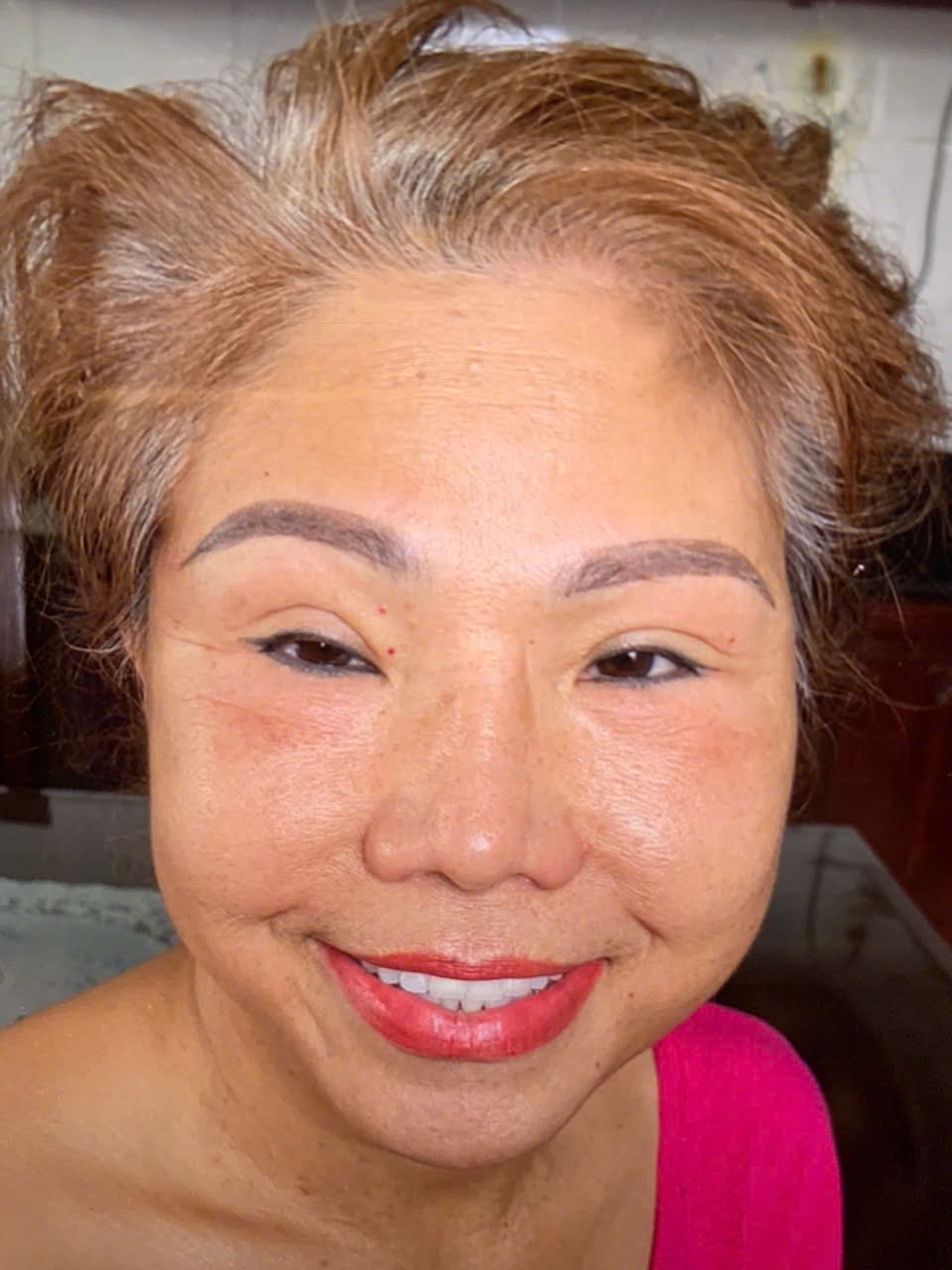 Phẫu Thuật Căng Da Mặt Toàn Phần ( Deep Plane Face Lift )