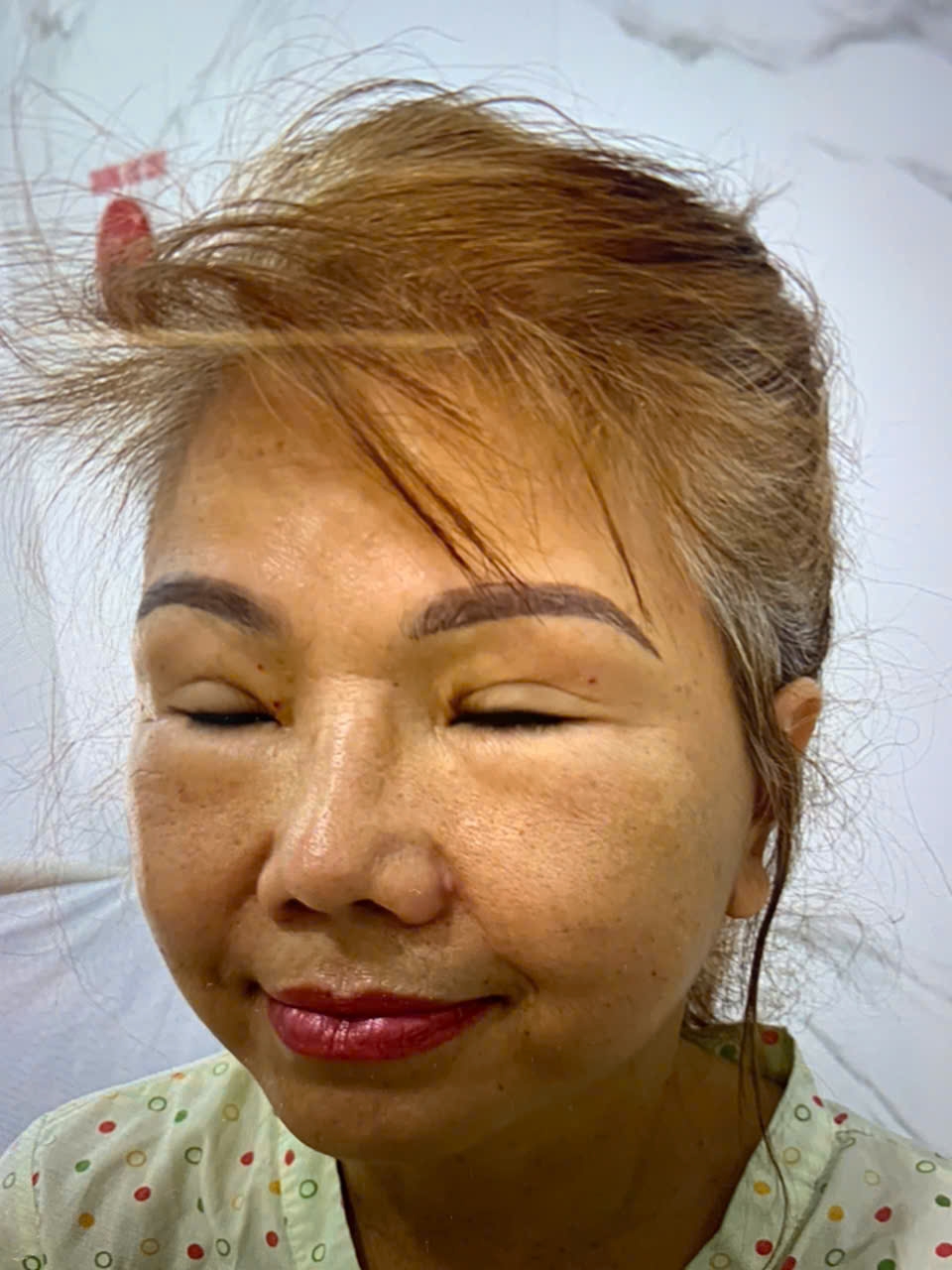 Phẫu Thuật Căng Da Mặt Toàn Phần ( Deep Plane Face Lift )