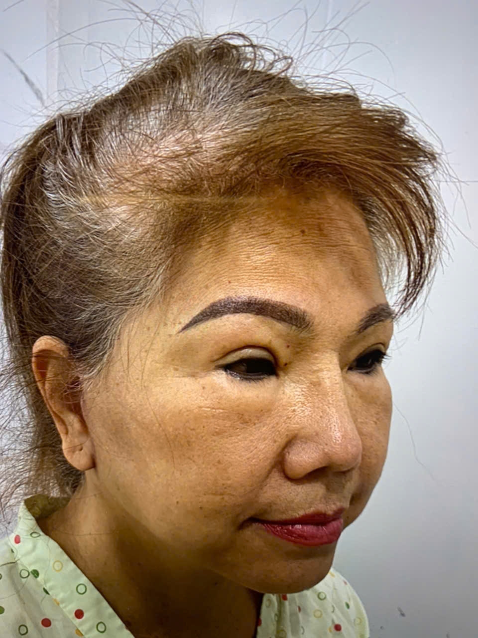 Phẫu Thuật Căng Da Mặt Toàn Phần ( Deep Plane Face Lift )