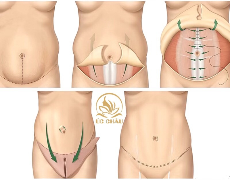Hút mỡ (Liposuction) Hút mỡ (Liposuction)