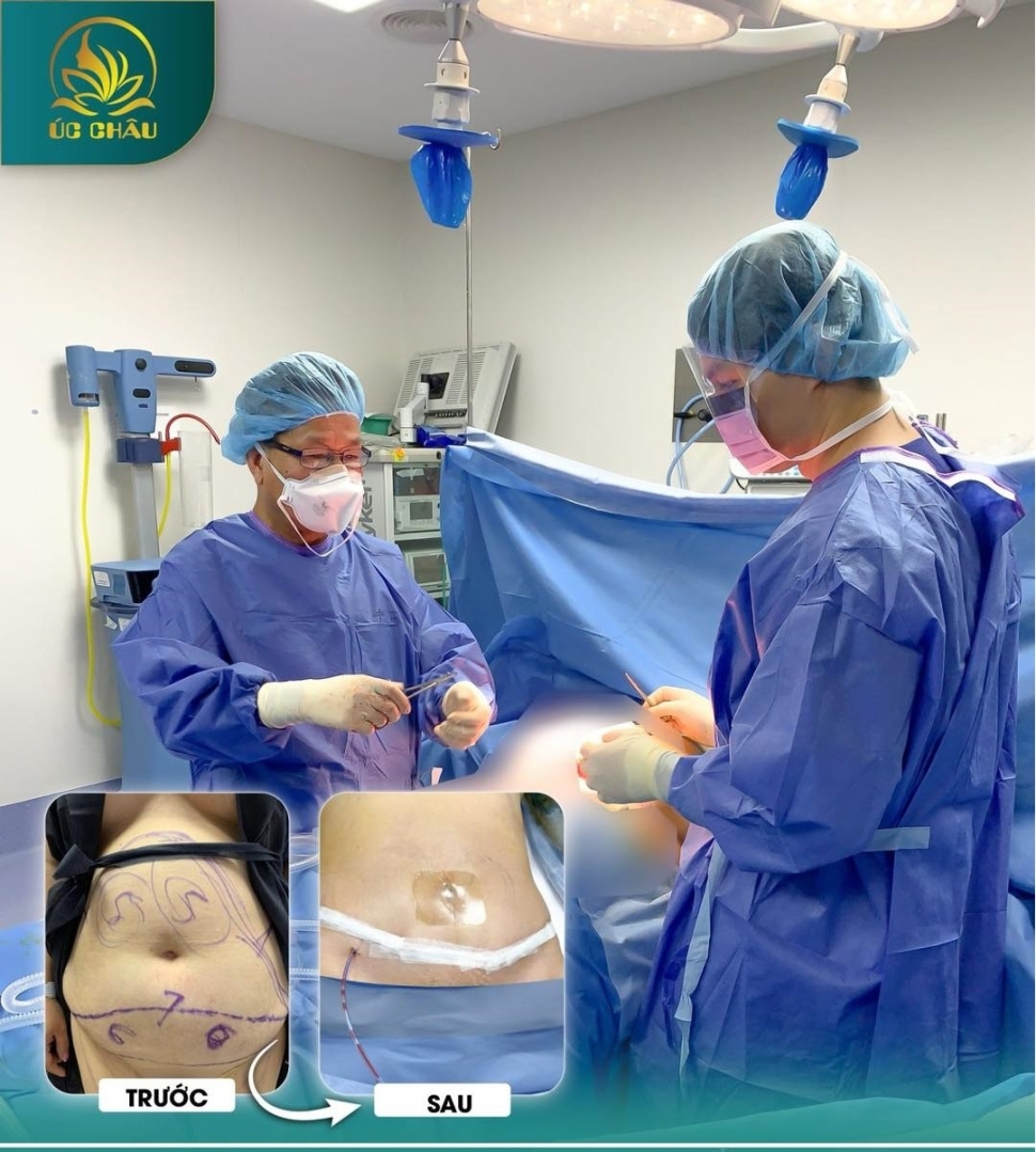 Hút mỡ (Liposuction) Hút mỡ (Liposuction)