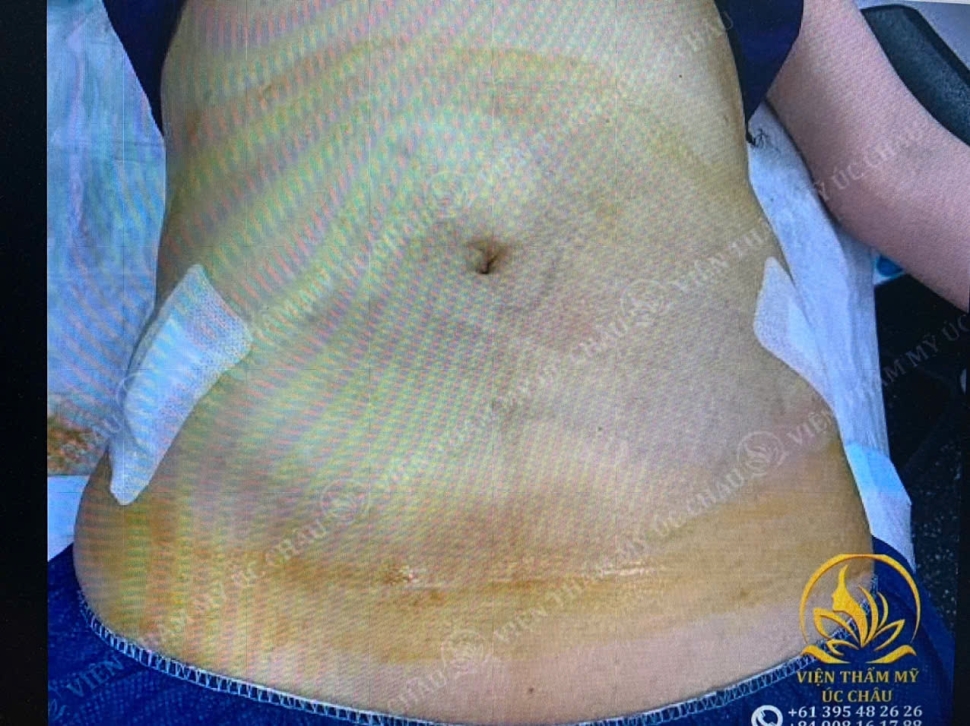 Hút mỡ (Liposuction)