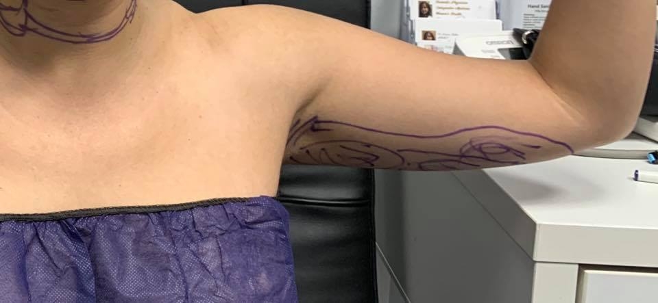 Hút mỡ (Liposuction) Hút mỡ (Liposuction)