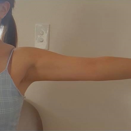Hút mỡ (Liposuction) Hút mỡ (Liposuction)