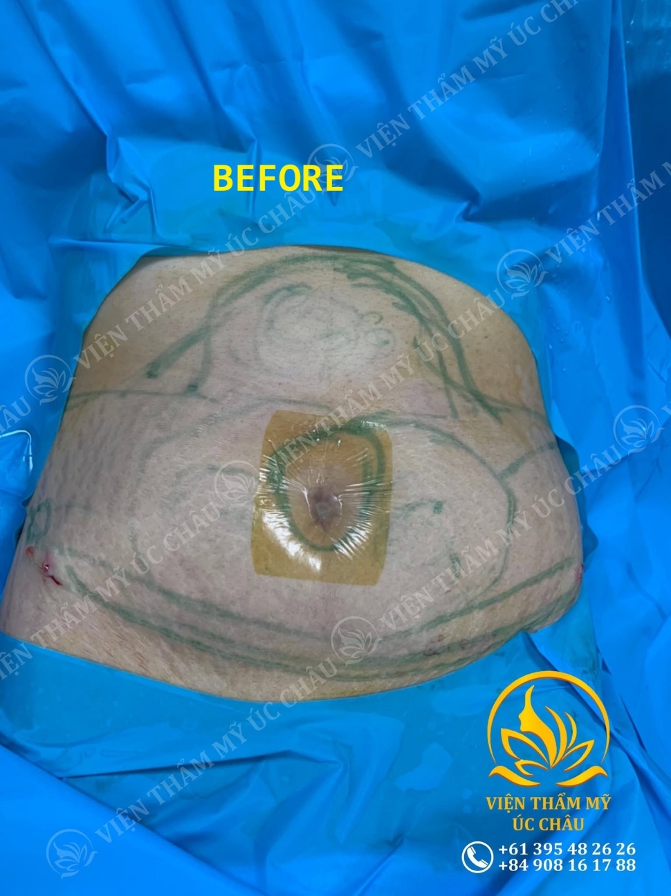 Liposuction