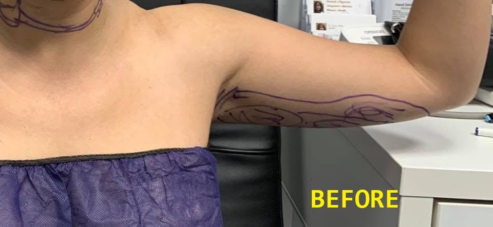 Liposuction