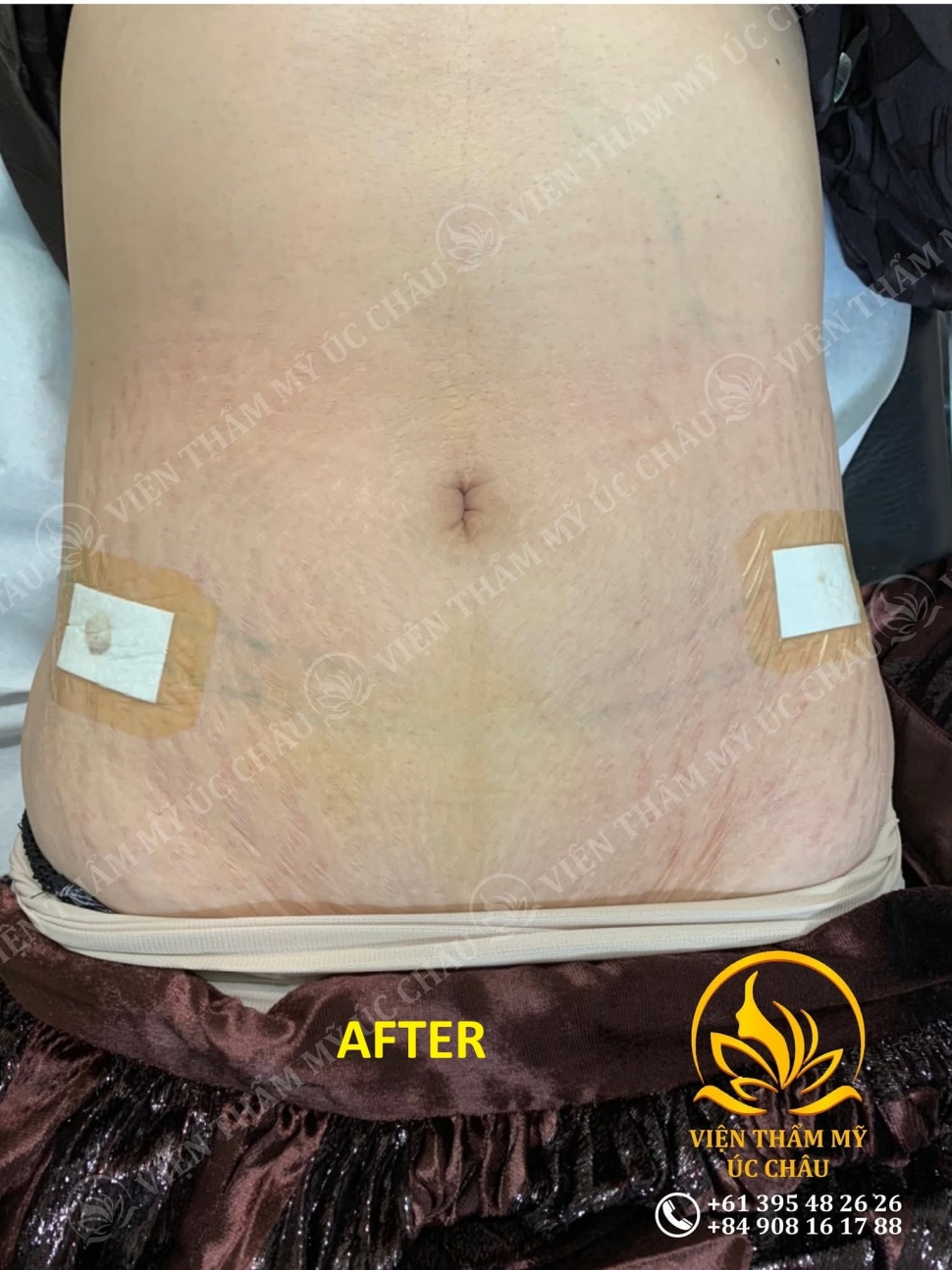 Liposuction