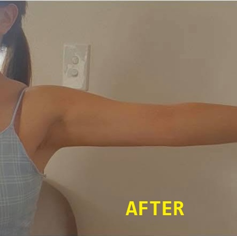 Liposuction