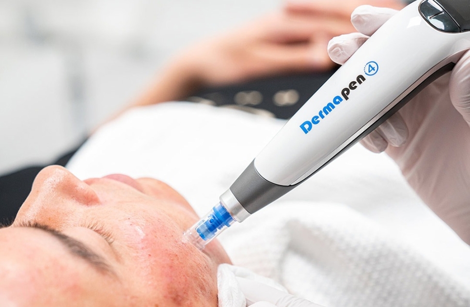 Microneedling: Dermapen Microneedling: Dermapen